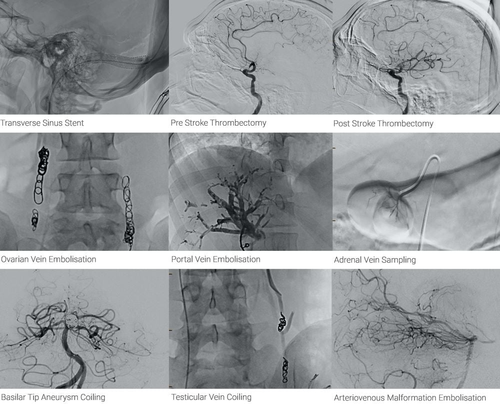 Over the past few years, SCP Radiology has built a dedicated interventional radiology unit to improve patients’ access to minimally invasive treatment options. Today, the team performs interventional procedures daily with a growing number of clinicians referring their patients for specialised treatment under image guidance.